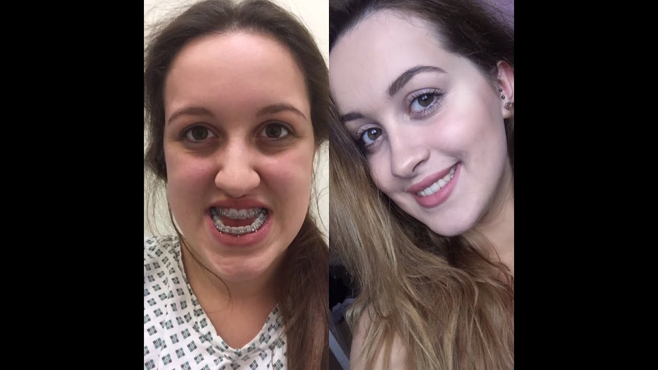 My Double Jaw Surgery Experience Youtube