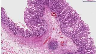 Hyperplastic Polyp Histopathology - Madeformedical