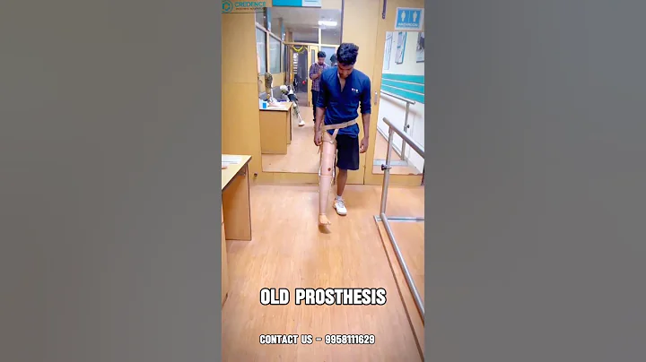 🫨😱🤯Above Knee Leg | Artificial Leg | Nakli Tang | Above Knee Prosthesis | Jaipur Foot | #ossur