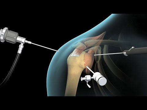 Reparación artroscópica del manguito de los rotadores