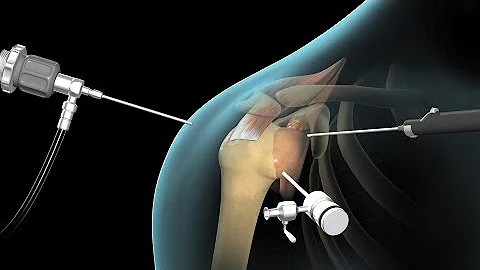 ¿Puede levantar el brazo con una rotura completa del manguito de los rotadores?