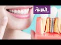 صباح العربية | تقنيات جديدة تجعل زراعة الأسنان أكثر سهولة