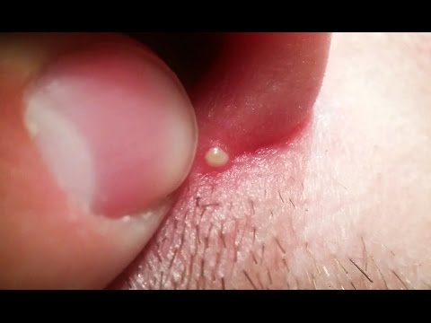 Pimple popping under nose