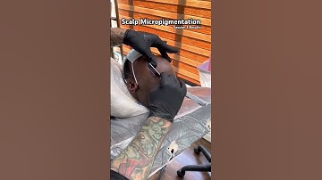 SMP Session 1 results #scalpmicropigmentation #hairlosstreatment #smp #edmonton