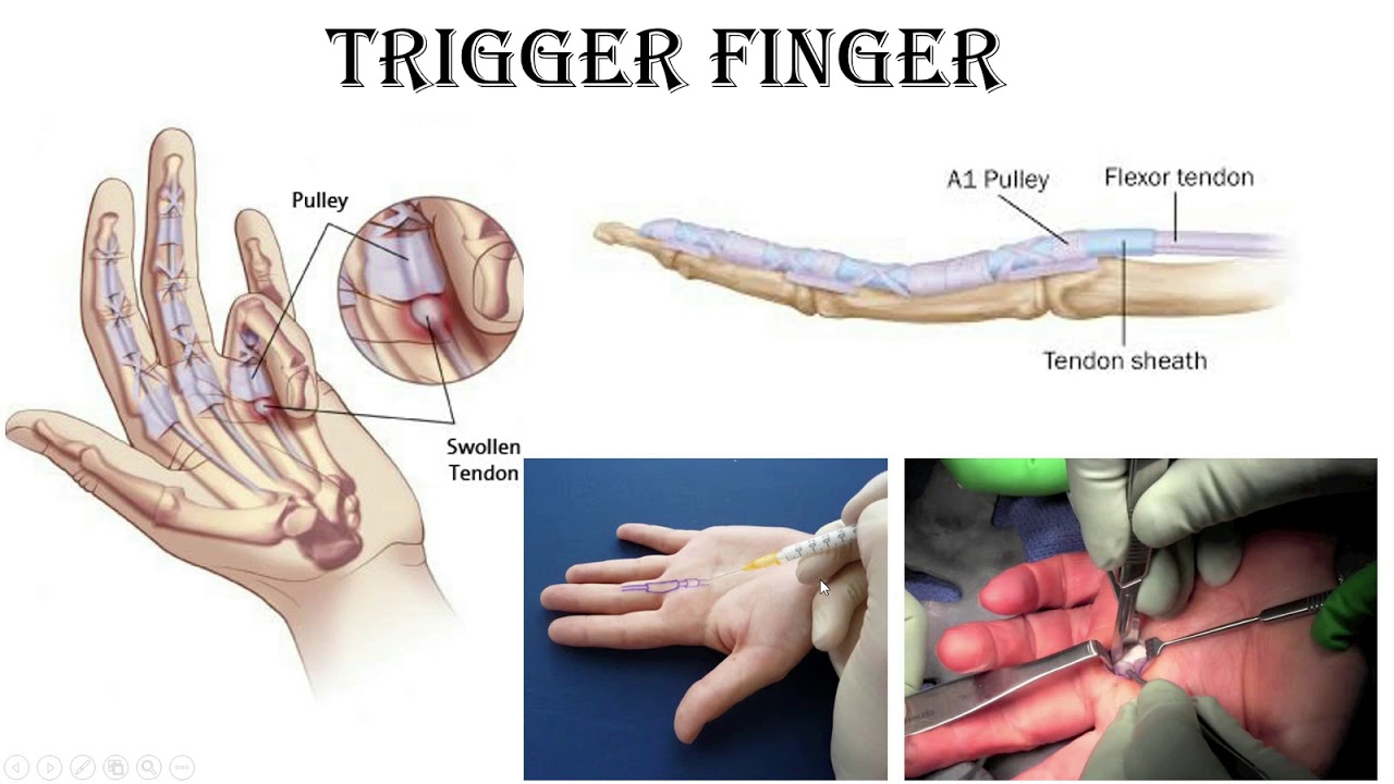 Trigger Finger.