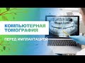 💻  Компьютерная томография зубов перед имплантацией