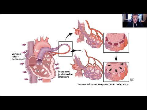 LV Failure and PPV, hemodynamic effects of positive pressure ventilation