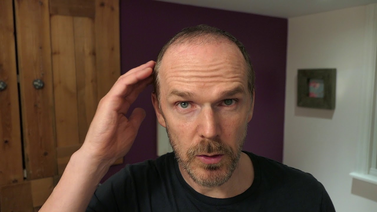 3 MONTHS AFTER MY HAIR TRANSPLANT YouTube