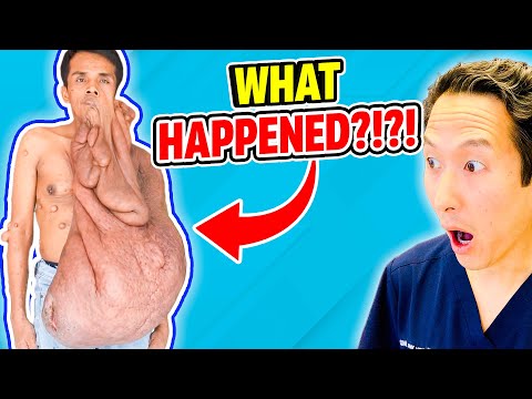 Plastic Surgeon Reacts to Man with 70 lbs Tumors of His Face! EXTREME Bodies Explained!