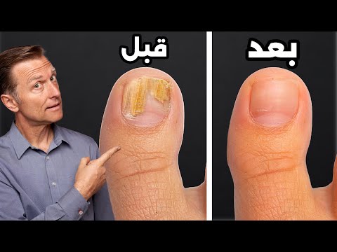 أسرع طريقة للإزالة الفطور وفطريات القدم