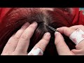 Immersive asmr scalp care  dandruff removal  no talking