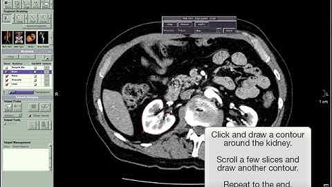 Vitrea Advanced segment using sculpt demo