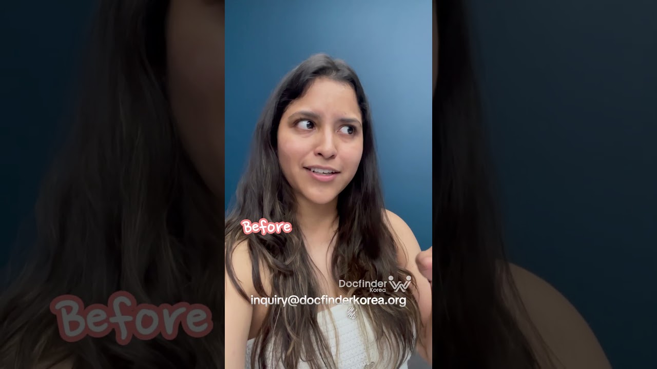 1 month after Rhinoplasty in Korea✨