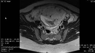 CASE 980 MRI PLACENTA PREVIA INCRETA