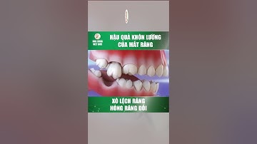 Hậu quả do mất răng | Trồng răng Implant