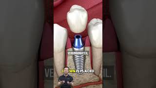 So läuft das Einsetzen eines Zahnimplantats wirklich ab #dentist