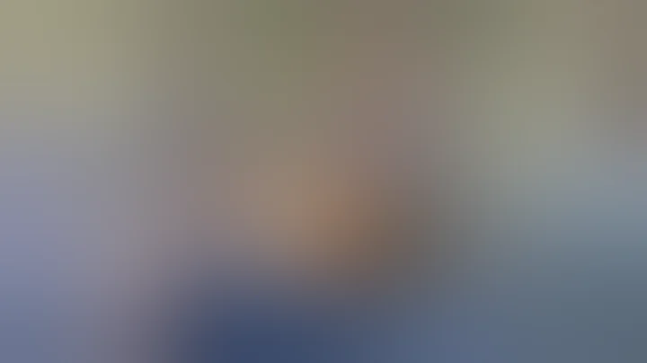 Total Hip Arthroplasty in a Patient with Spondyloepiphyseal Dysplasia - Dr. Donald Hohman