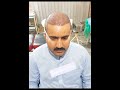 Hair Transplant Islamabad Pakistan..#viral #skincare #status #pakistan