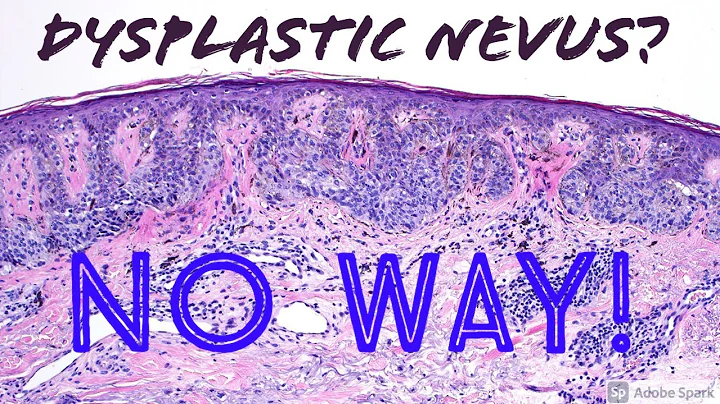 Melanoma (Lentigo Maligna Type) vs Dysplastic Nevu...