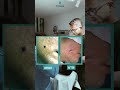 Mole Removal with Surgery & Laser ✨
