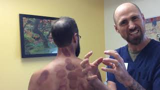 Cupping aka Myofascial Decompression. What, How, and Why?