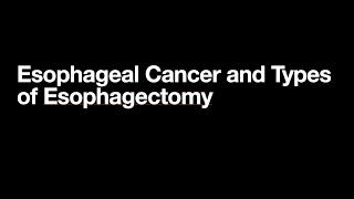 The Three Types of Esophagectomy