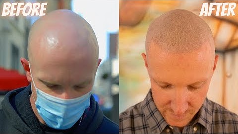 INSPIRING Scalp Micropigmentation Transformation