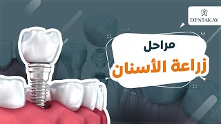 دينت أكاي | مراحل عملية زراعة الأسنان