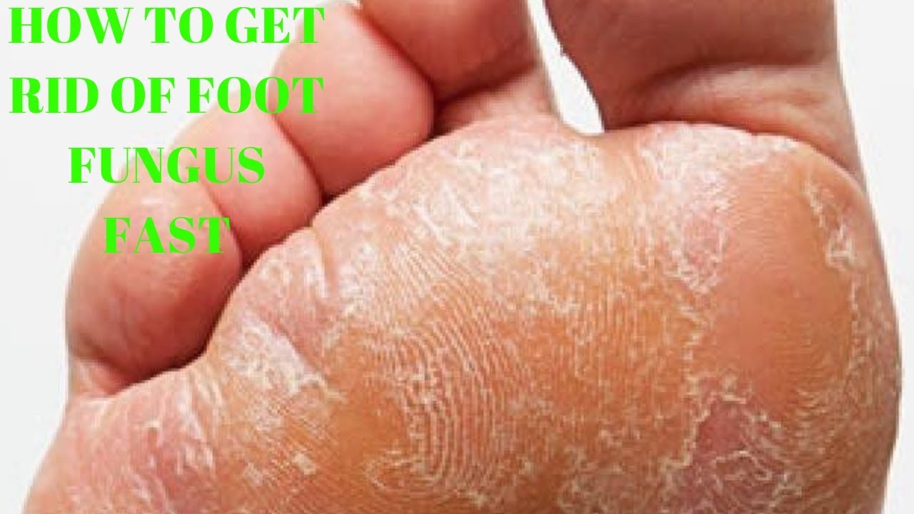 how to get rid of foot fungus fast YouTube