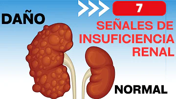 ¿Cuáles son las 3 principales causas de insuficiencia renal?