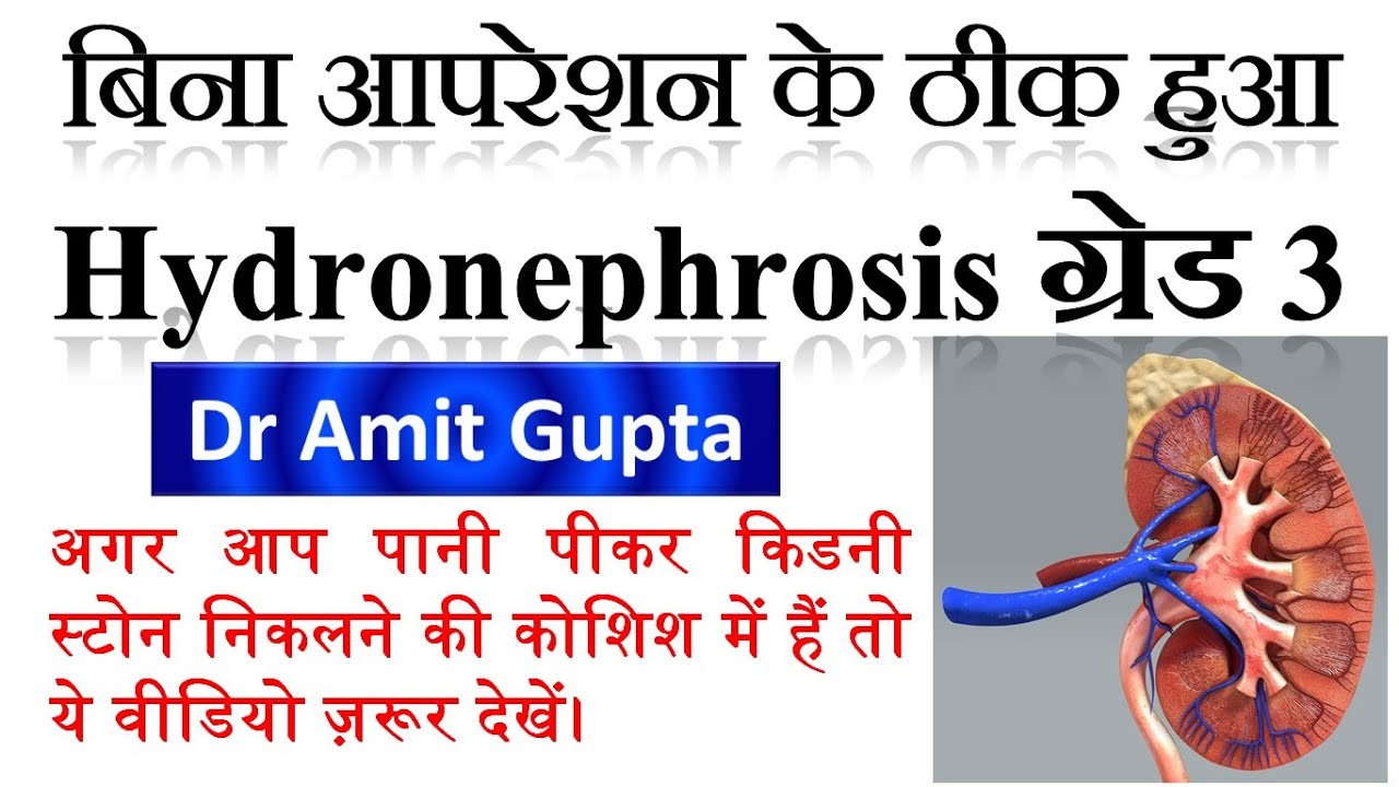 Cured case of Hydronephrosis Grade-3 (Homoeopathy did magic in Hydronephrosis)