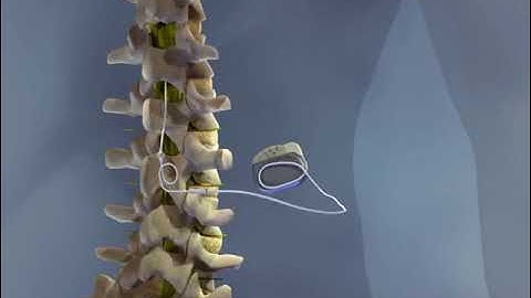 Dr. Georgios Matis - Neuromodulation - Spinal Cord Stimulation - Instructional video - Biomechanics