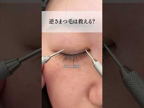 【二重整形】逆さまつ毛は救える? #shorts