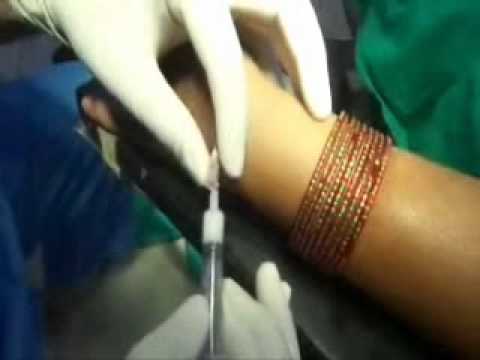 Wrist Ganglion aspiration technique wrist tendonitis