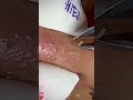 Skincare | Blackheads Removal #290 #tweezers skincare #blackheads blackheads
