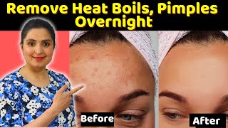 Cure Prickly HEAT RASHES, SWEAT PIMPLES, HEAT BOILS / Ancient Remedy to remove prickly heat rashes