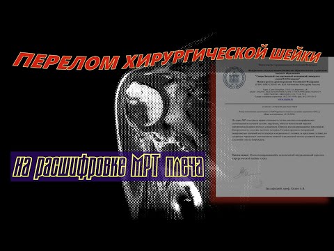 Аддукционный ПЕРЕЛОМ ХИРУРГИЧЕСКОЙ ШЕЙКИ плеча на расшифровке МРТ плечевого сустава