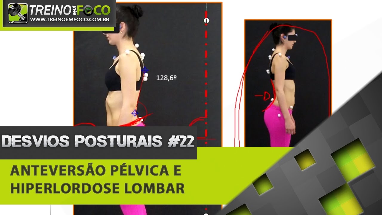 Anteversão Pélvica e Hiperlordose Lombar - Desvios Posturais #22