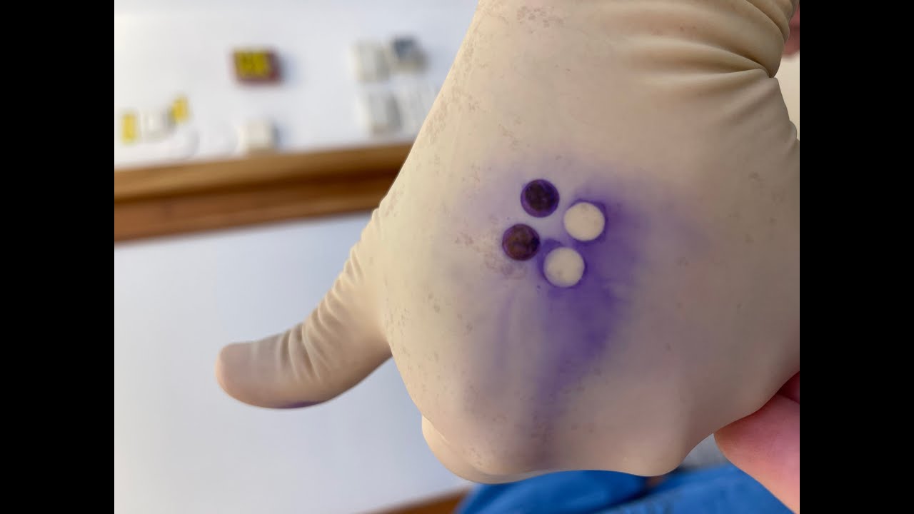 Smile - Small Incision Lenticule Extraction - YouTube