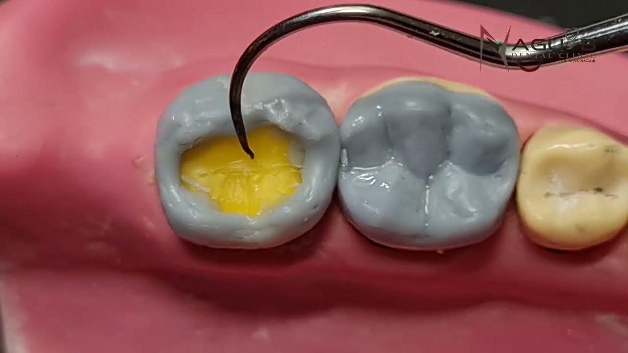 Full anatomical wax pattern of lower second molar