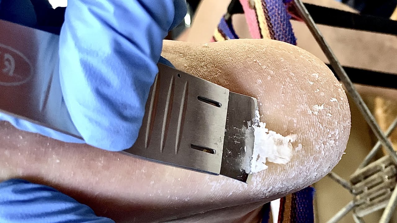 Feet callus removal& old skin cleaning【DT Pedicure】asmr 2 YouTube