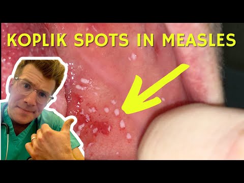 Doctor explains Koplik Spots seen in Measles (with examples) | Doctor O&rsquo;Donovan