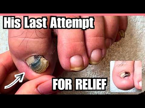 Pain Relief for Extreme Ram’s Horn Toenail Transformation | Meticulous Manicurist