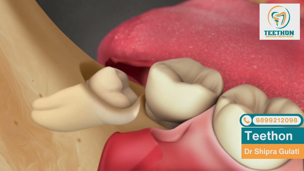 3rd molar Extraction