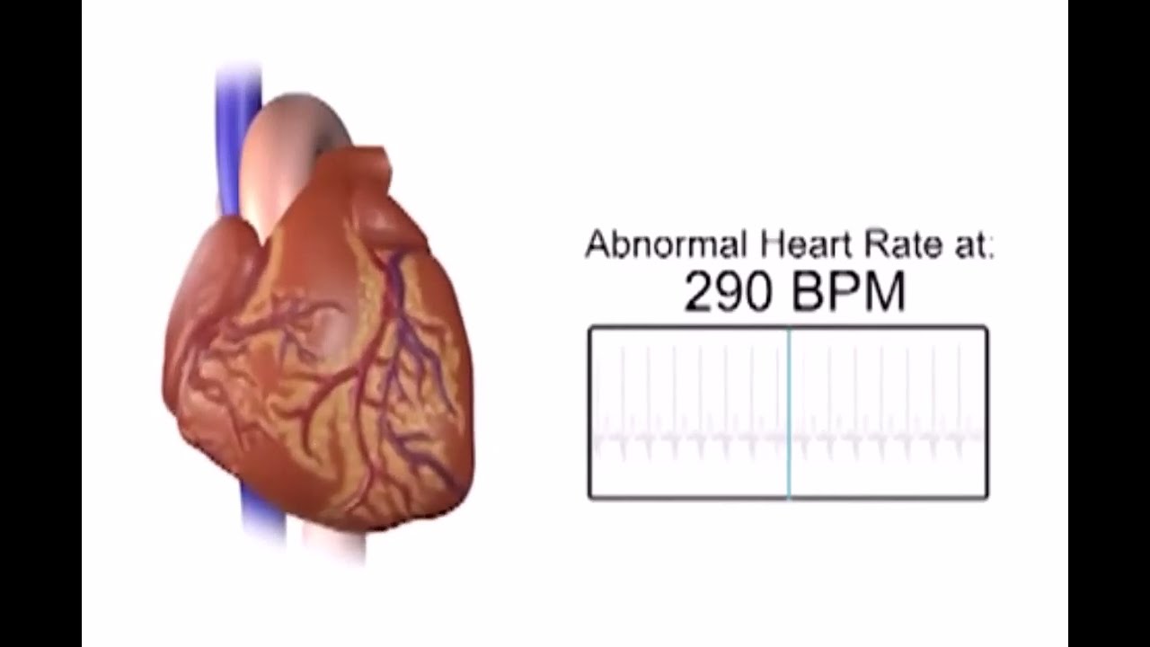 Inappropriate Sinus Tachycardia YouTube Inappropriate Sinus Tachycardia YouTube
