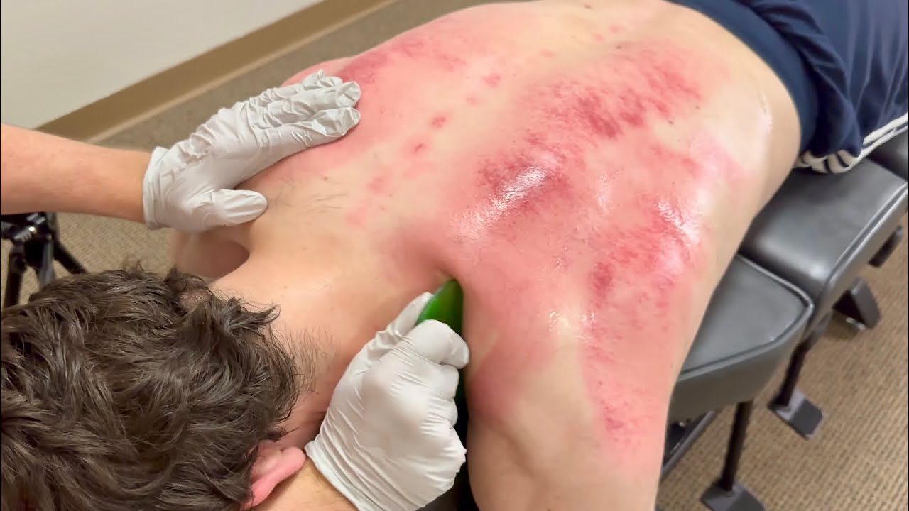 MONSTROUS KNOTS IN SHOULDER RECEIVE INTENSE TISSUE WORK