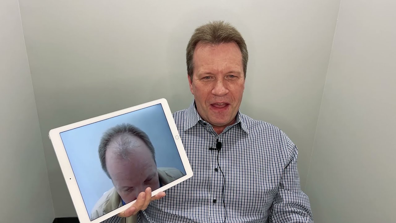 Norm's Hair Restoration Testimonial - Advanced Hair
