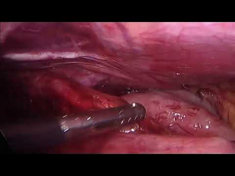 Ooforoplastia por video (cisto dermoide) / Video oophoroplasty (dermoid  cyst) 