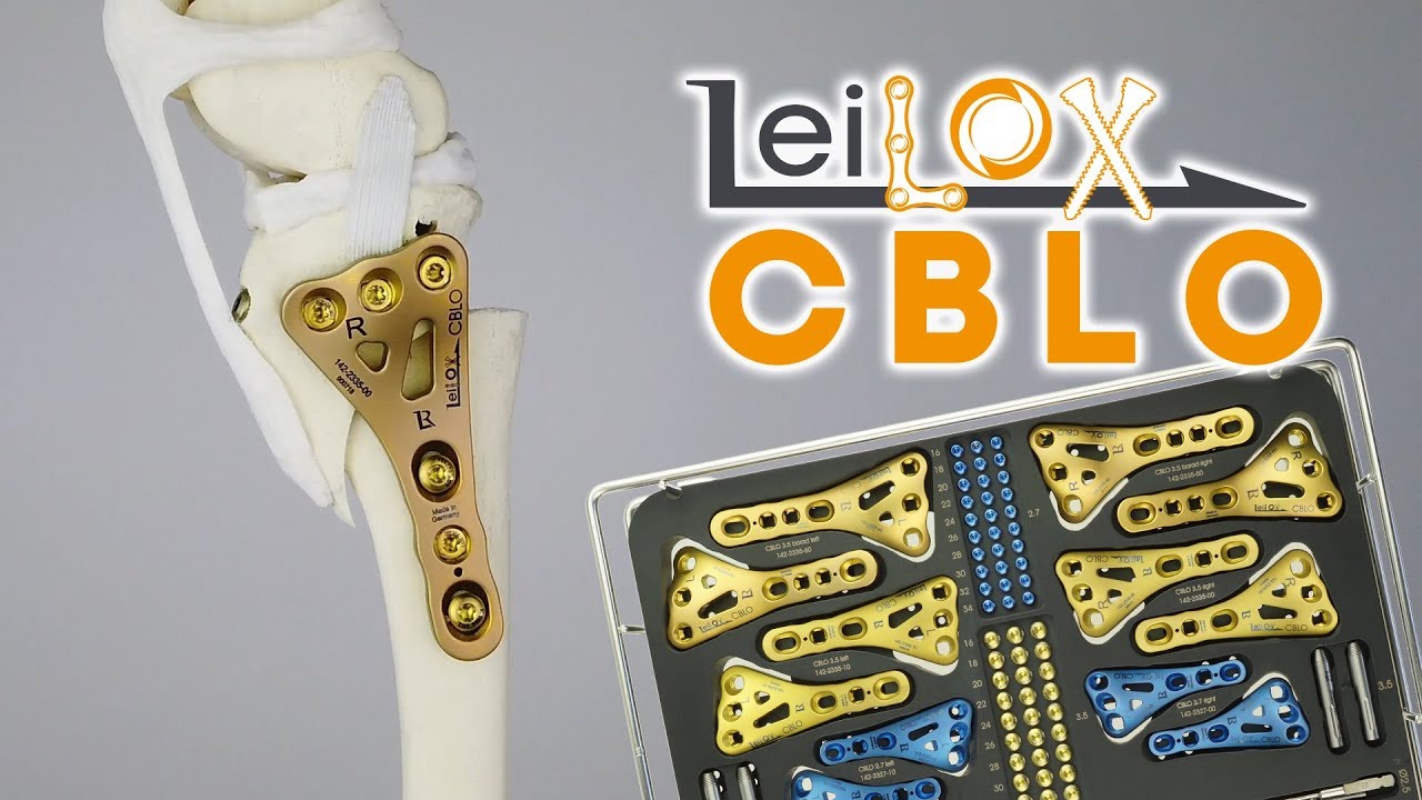 CBLO Titanium Locking Implants by Leibinger - YouTube