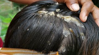 Itchy Dry Scalp and Scratching Treatment - Psoriasis - Dandruff Removal - Huge Flakes, Part 215